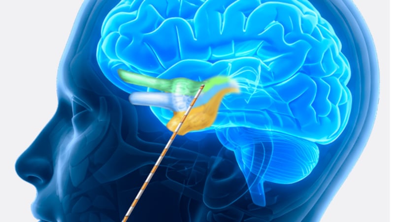 A surgeon at University Hospitals in Cleveland is performing radio frequency ablation to give...