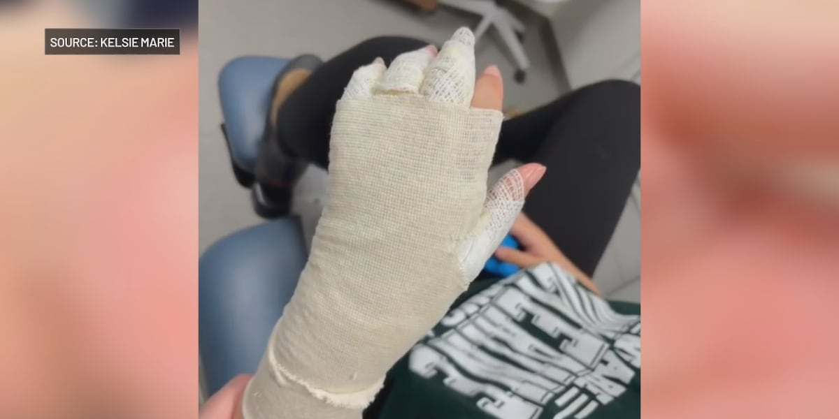 Needoh Explode Injuries Viral online ‘NeeDoh’ challenge leaves Cleveland child with severe burns