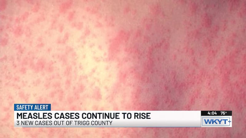 Kentucky sees uptick in measles cases as outbreak continues